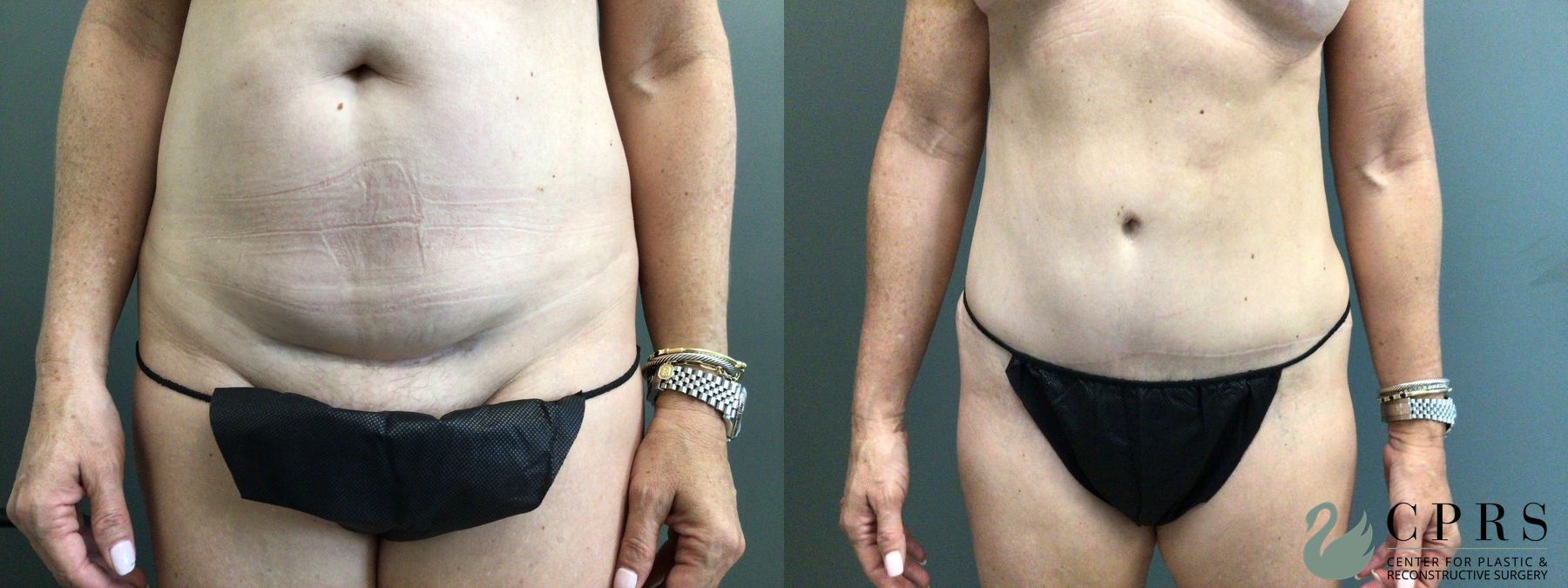Before and after Abdominoplasty case 43070
