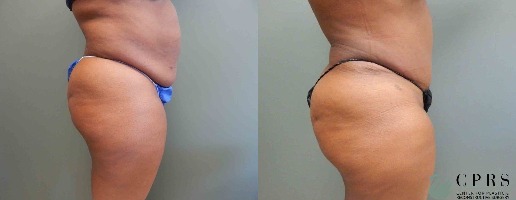 Abdominoplasty - Thumbnail 3