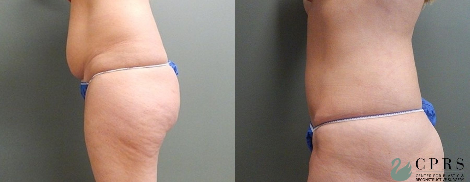 Before and after Abdominoplasty case 19009 - Angle 3