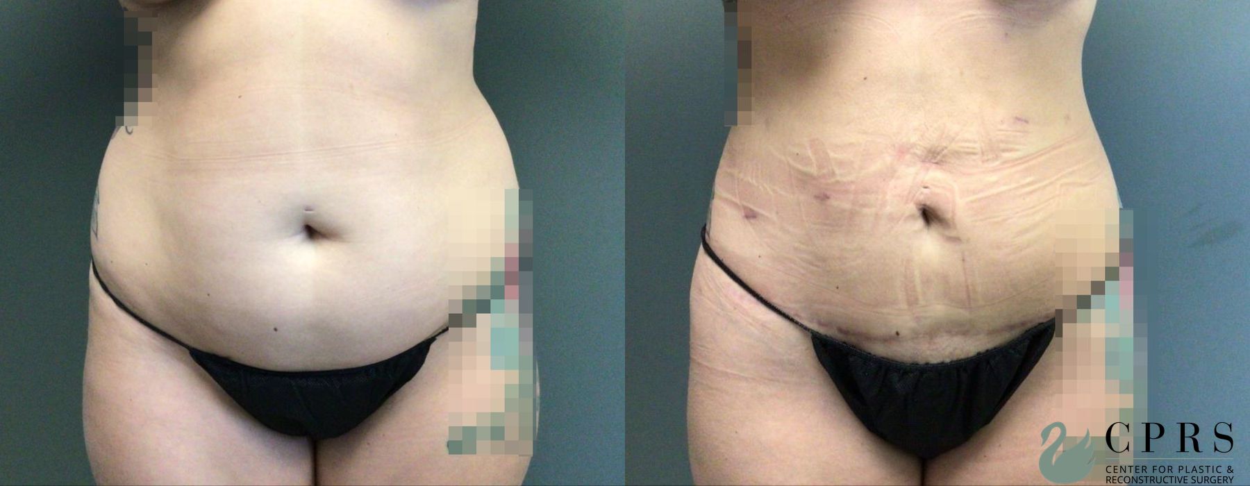 Before and after Abdominoplasty case 19170