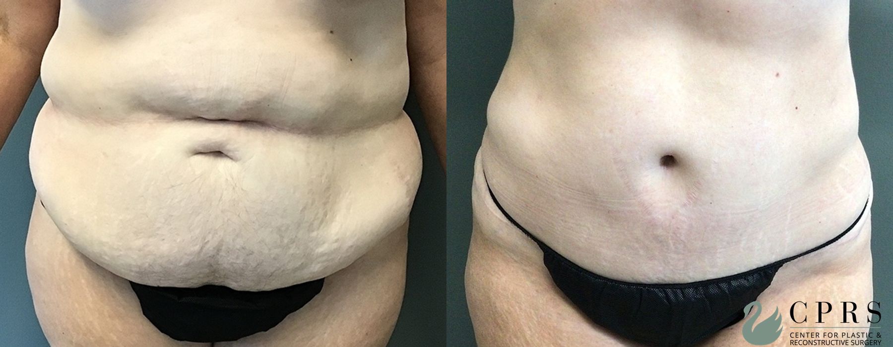 Abdominoplasty - Case 239548