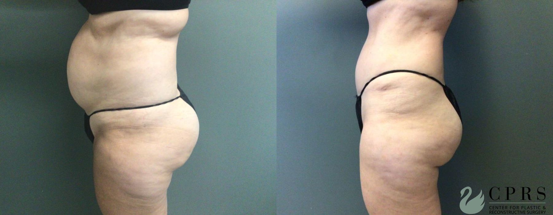 Before and after Abdominoplasty case 19032 - Angle 2