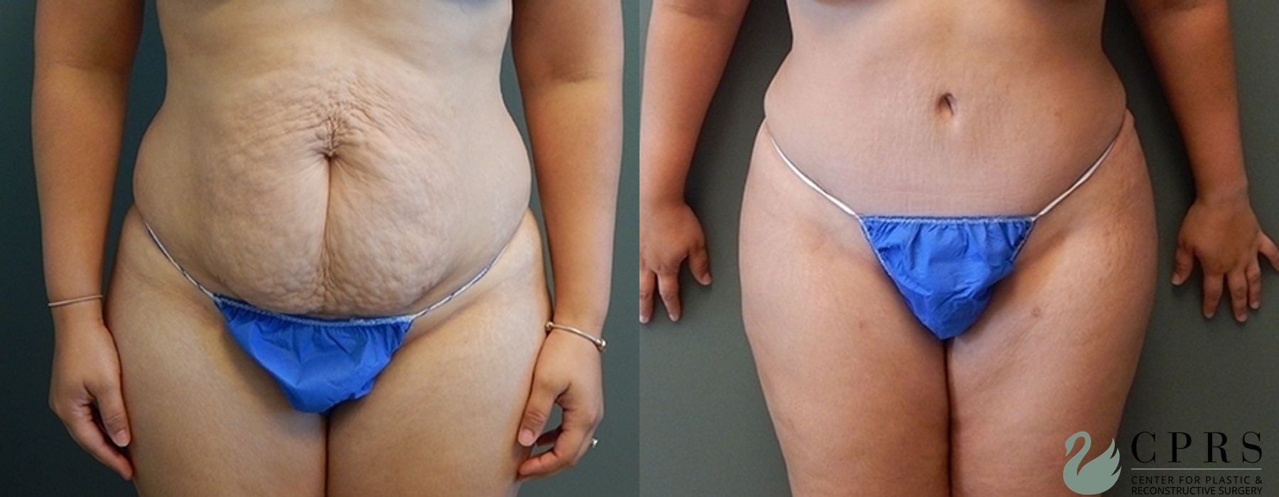 Before and after Abdominoplasty case 18924