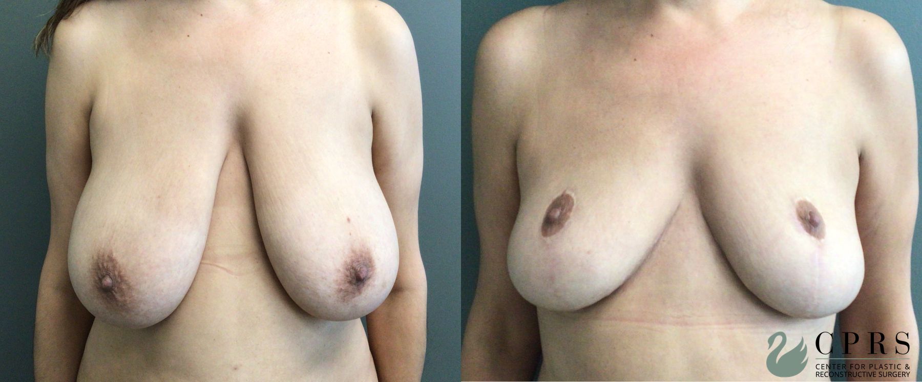 Before and after Abdominoplasty case 43546 - Angle 4