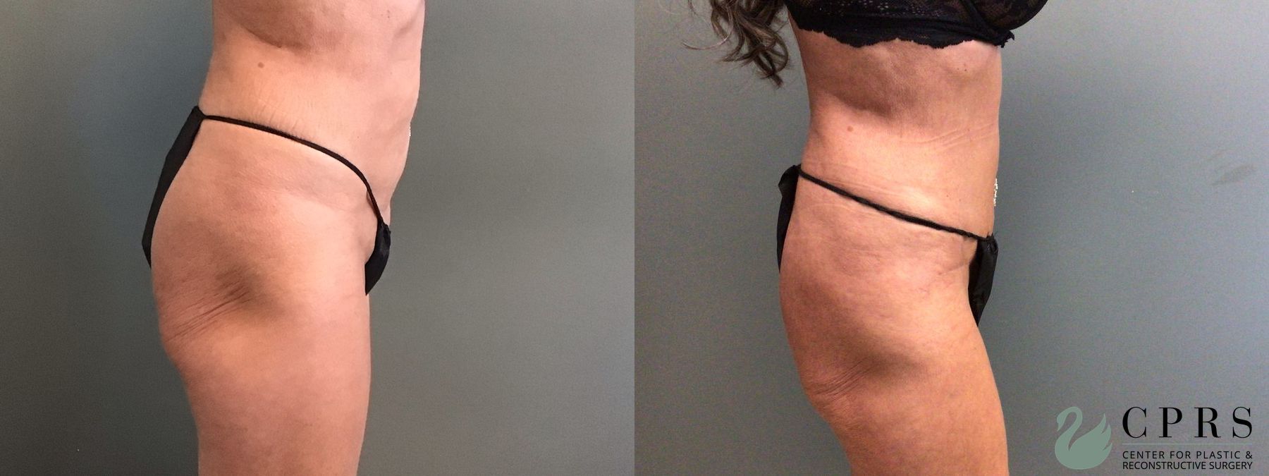 Before and after Abdominoplasty case 49394 - Angle 3