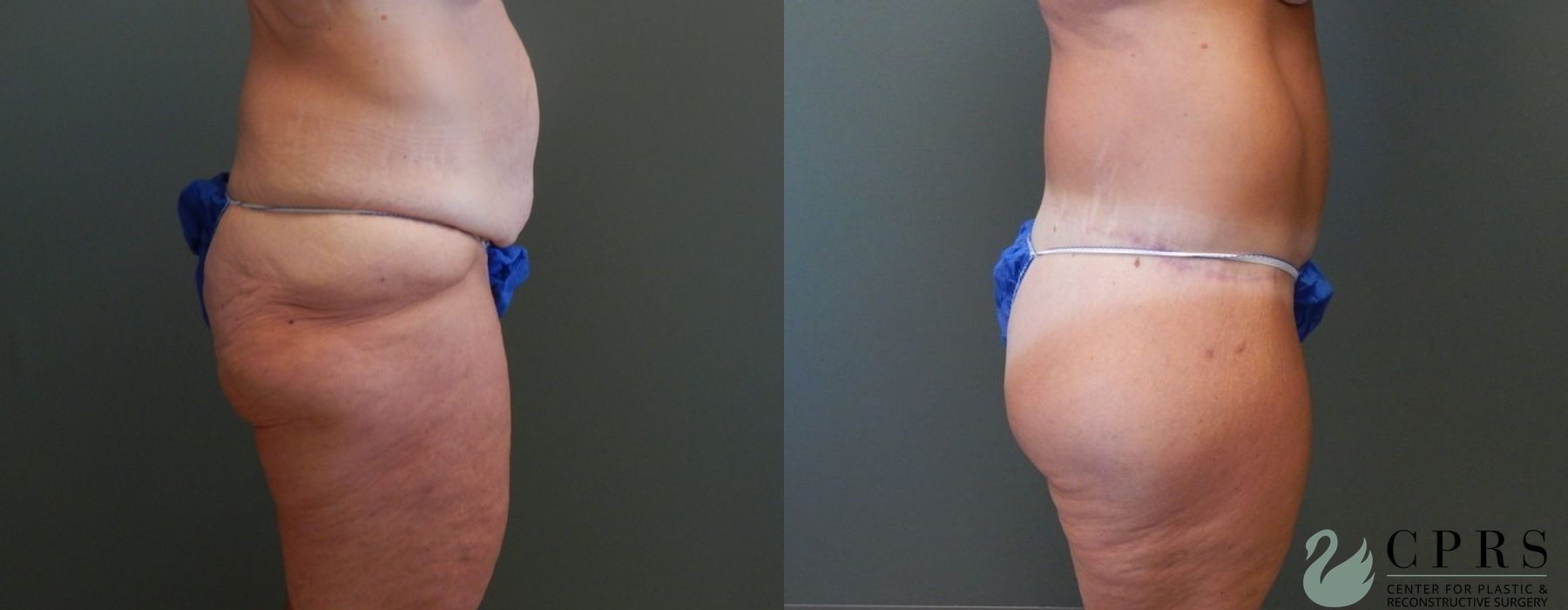 Before and after Abdominoplasty case 19000 - Angle 2