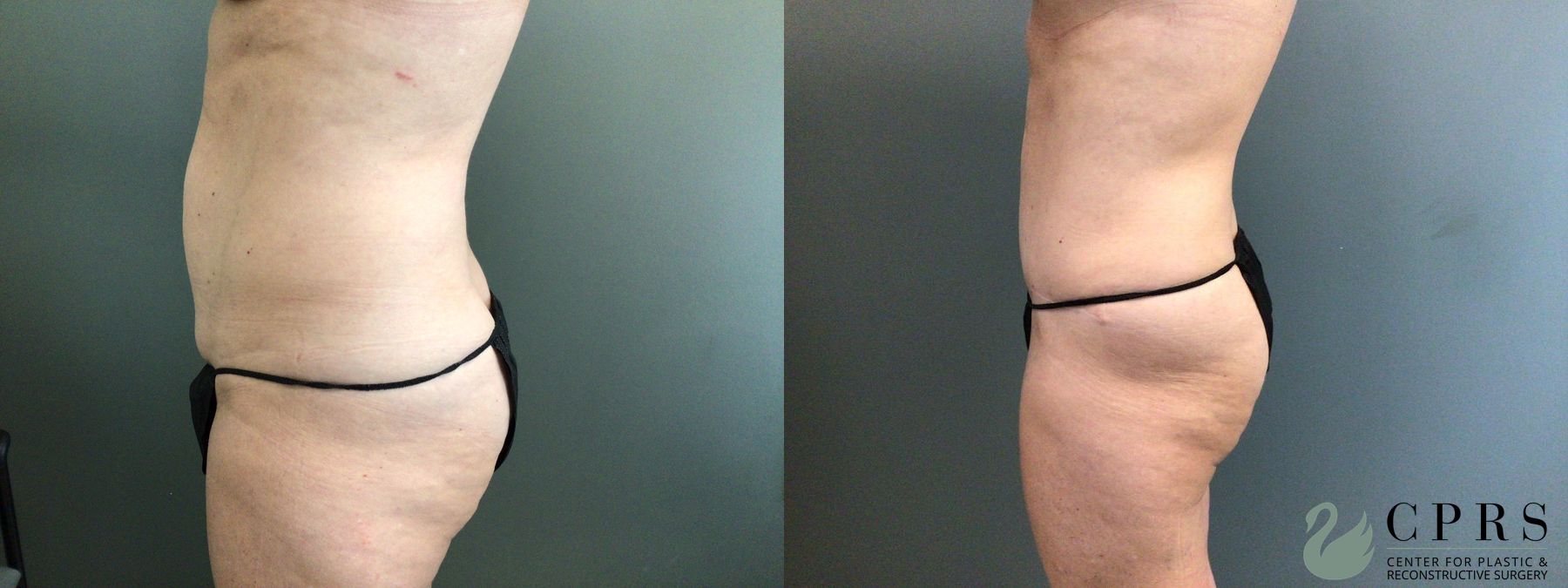 Before and after Abdominoplasty case 43070 - Angle 2