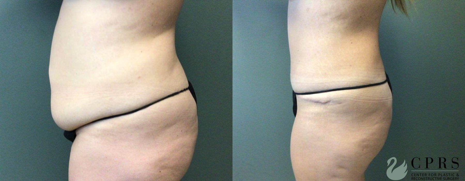 Before and after Abdominoplasty case 19201 - Angle 2