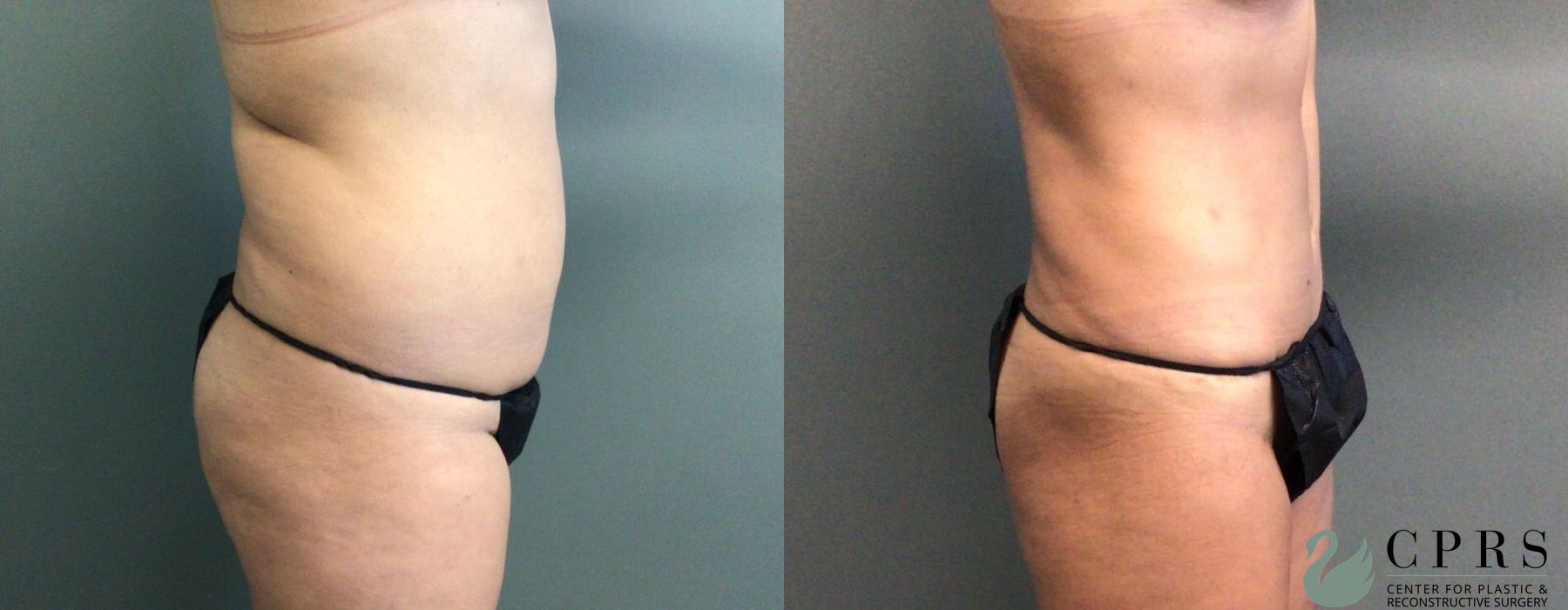 Before and after Abdominoplasty case 19151 - Angle 2