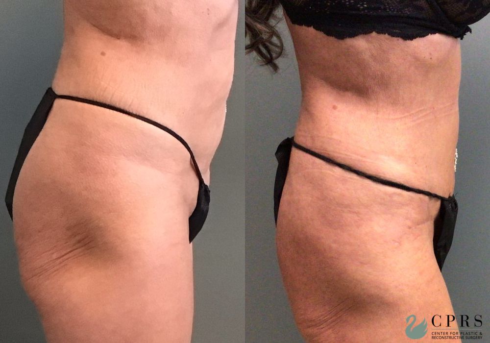 Before and after Abdominoplasty case 36794 - Angle 2