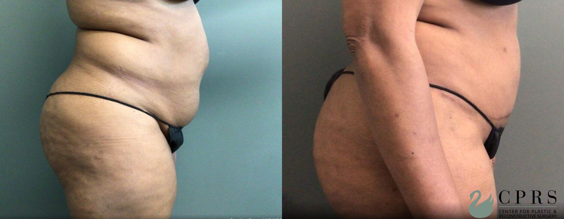 Before and after Abdominoplasty case 19187 - Angle 2