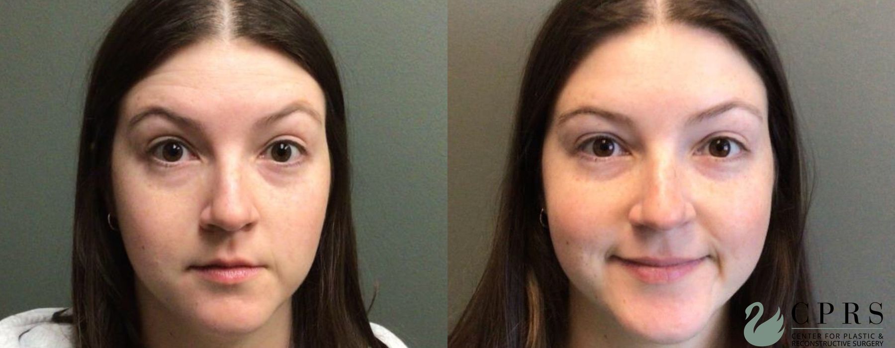 Before and after BOTOX® Cosmetic case 19016