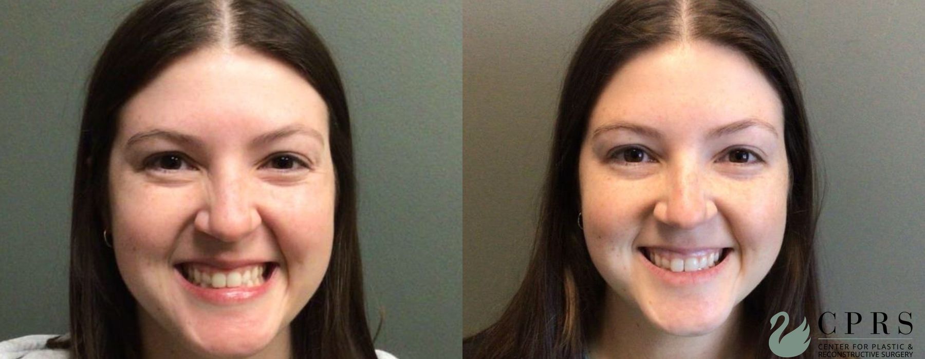 Before and after BOTOX® Cosmetic case 19016 - Angle 2