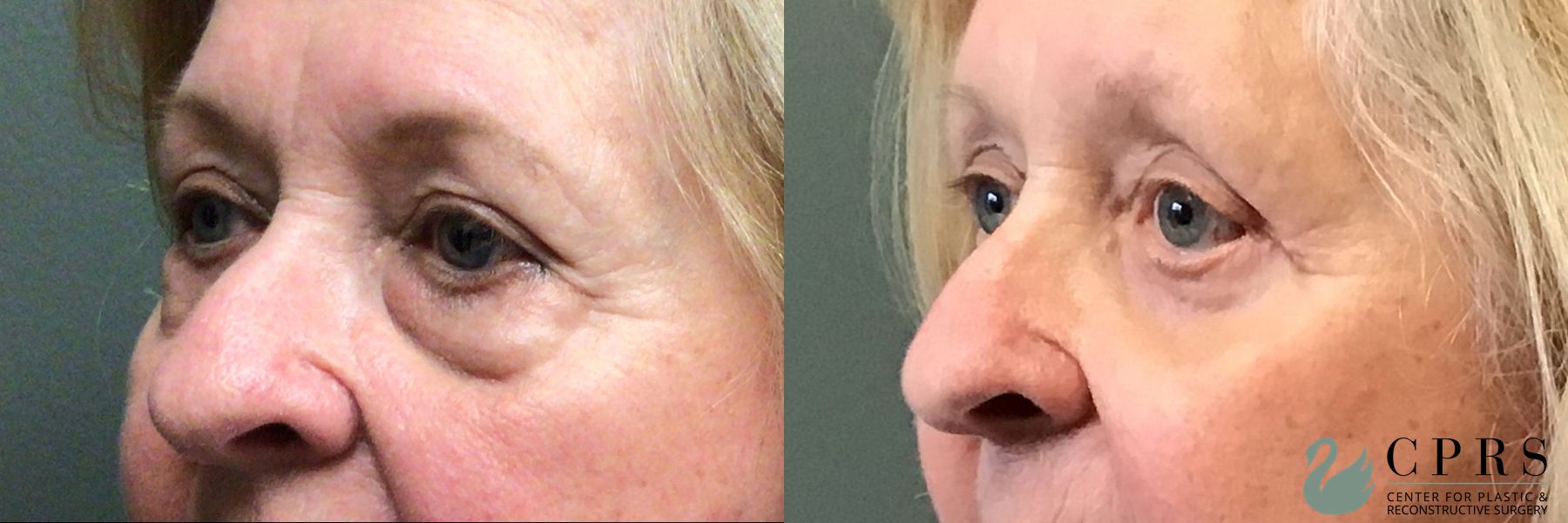 Before and after Blepharoplasty case 23854 - Angle 2