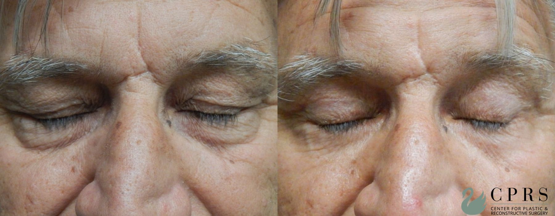 Before and after Blepharoplasty case 19001 - Angle 3