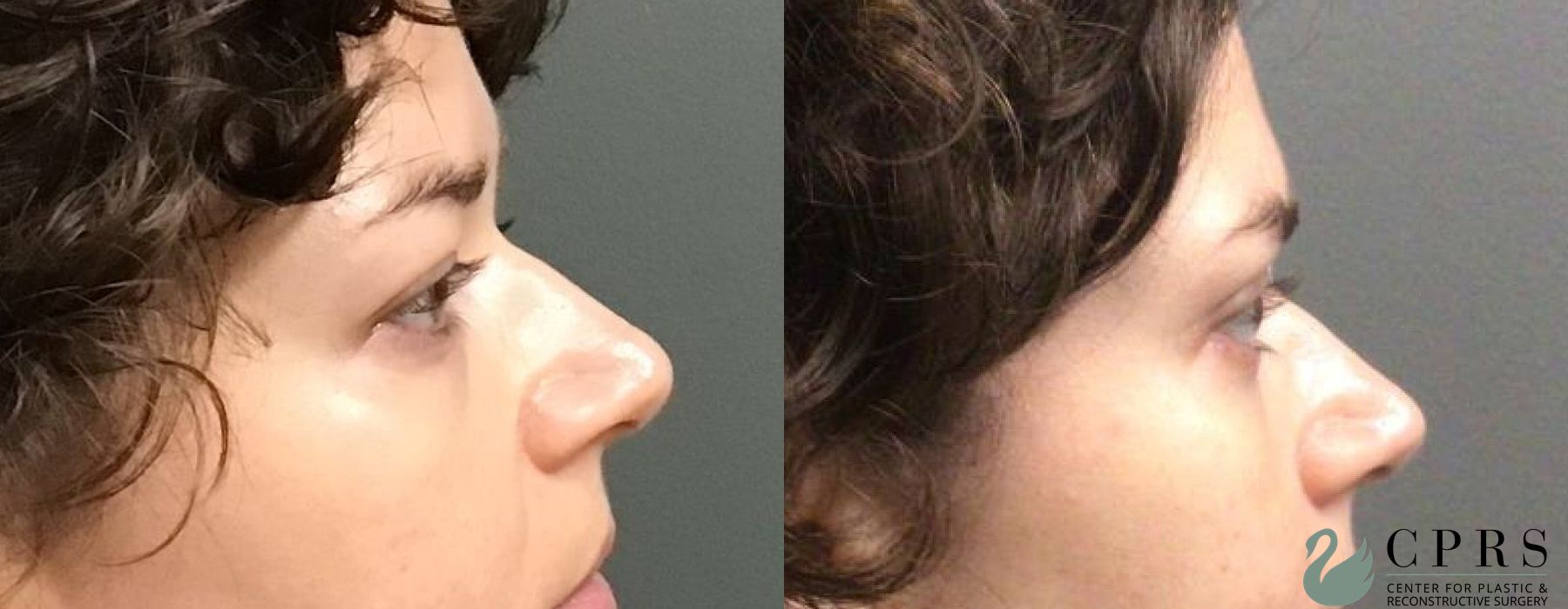 Before and after Blepharoplasty case 18998 - Angle 2