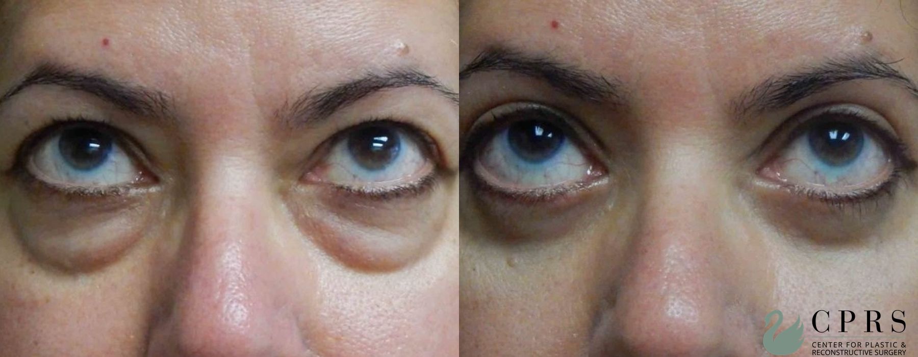 Before and after Blepharoplasty case 18933