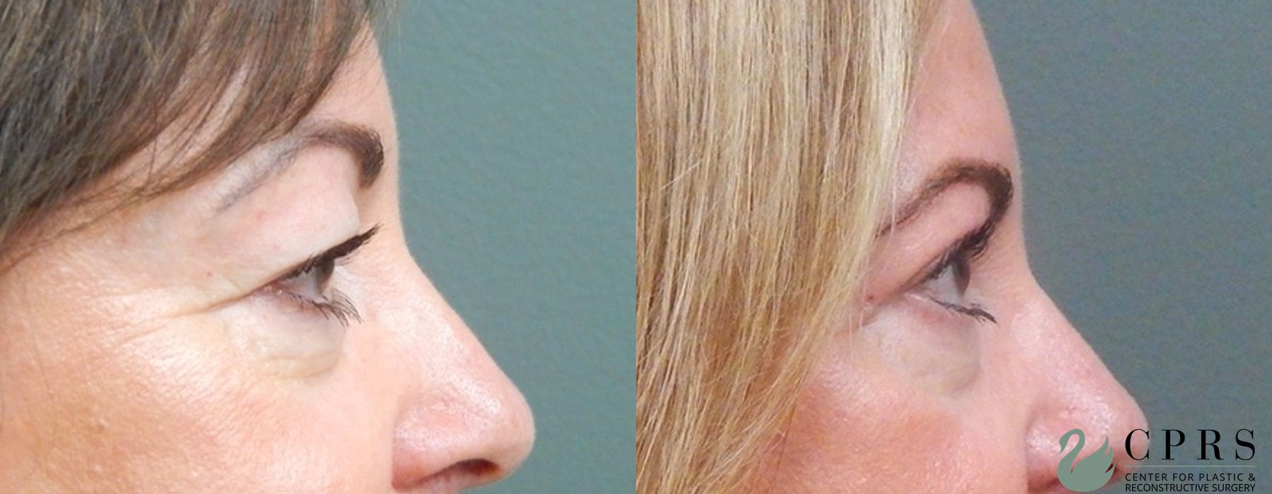 Before and after Blepharoplasty case 18958 - Angle 3