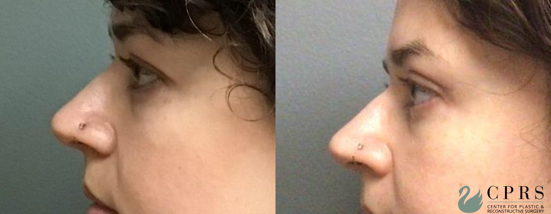 Before and after Blepharoplasty case 18998 - Angle 3