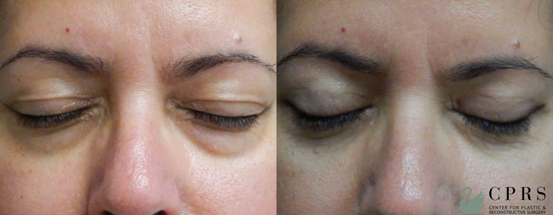 Before and after Blepharoplasty case 18933 - Angle 2