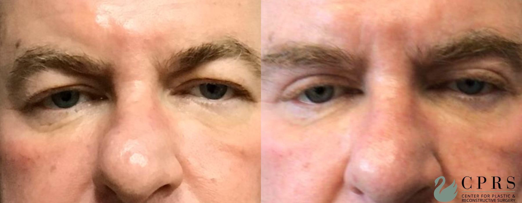 Before and after Blepharoplasty case 19119