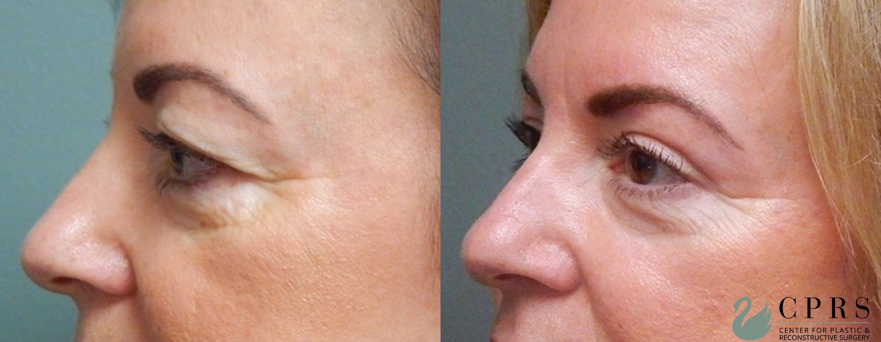 Before and after Blepharoplasty case 18958 - Angle 5
