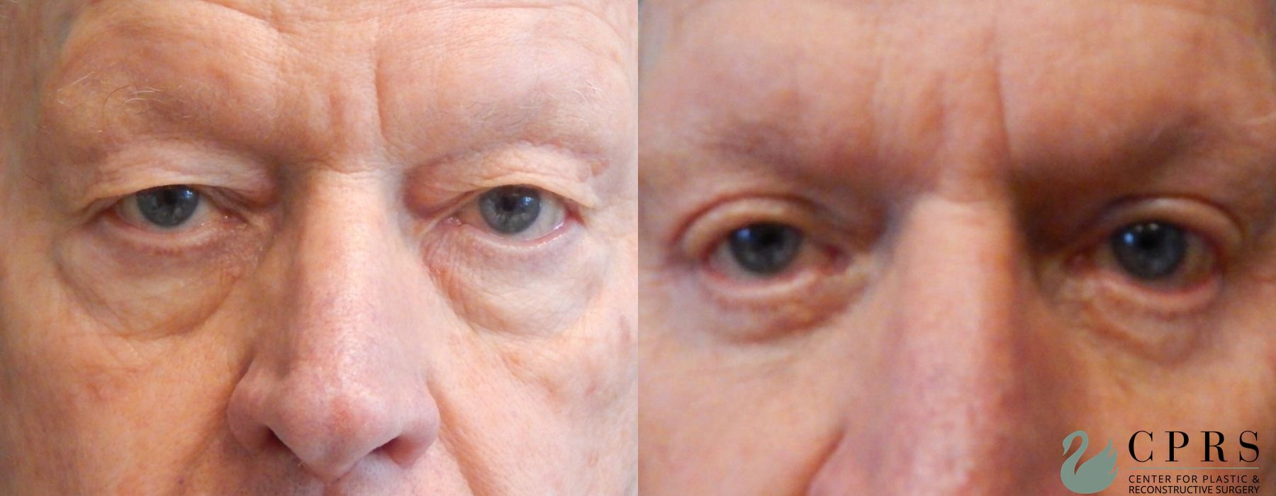 Before and after Blepharoplasty case 18981