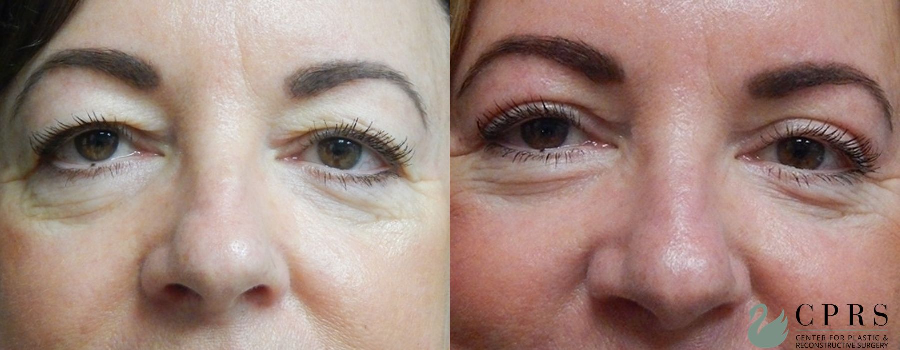 Before and after Blepharoplasty case 18958