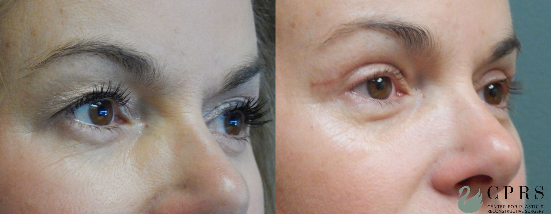 Before and after Blepharoplasty case 18925 - Angle 2