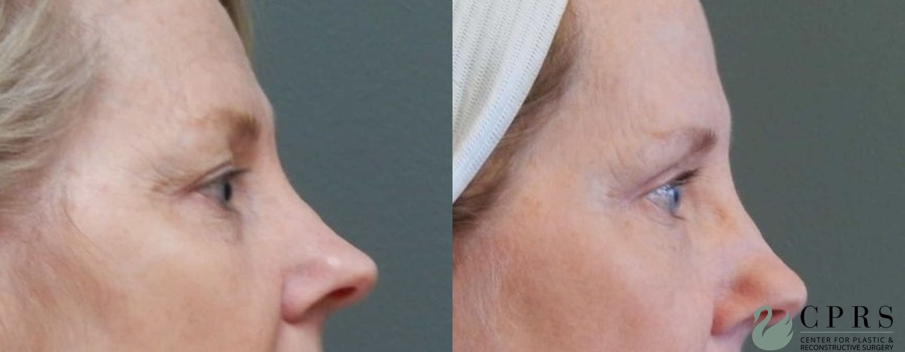 Before and after Blepharoplasty case 18968 - Angle 2