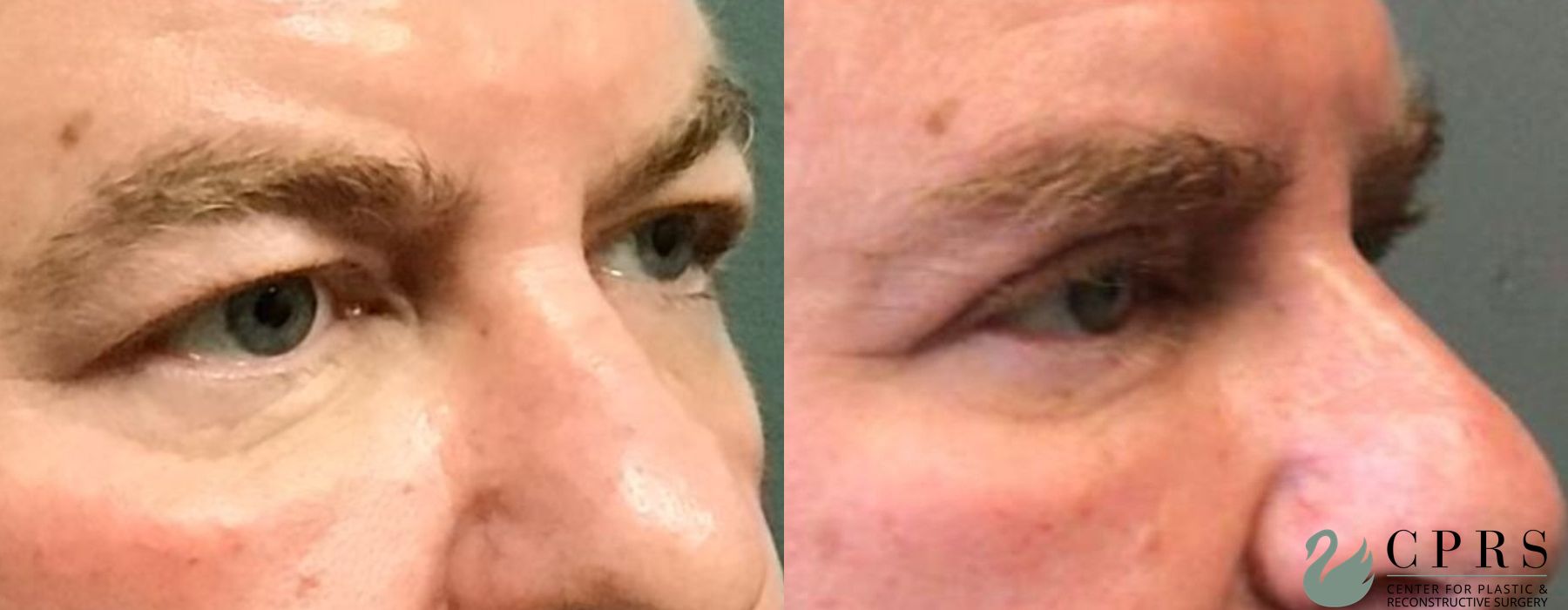 Before and after Blepharoplasty case 19119 - Angle 3