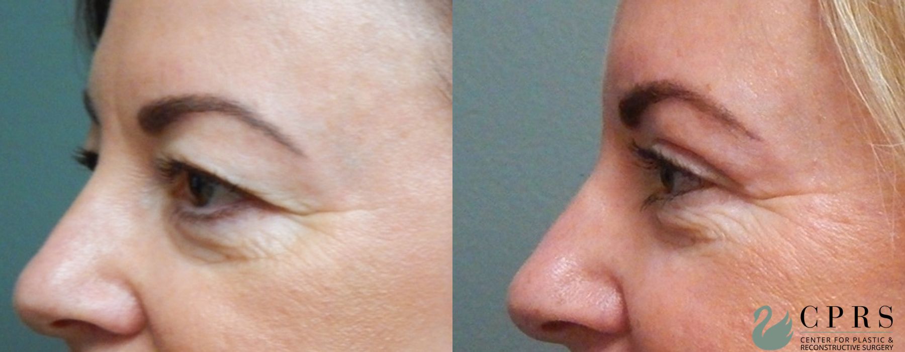 Before and after Blepharoplasty case 18958 - Angle 4