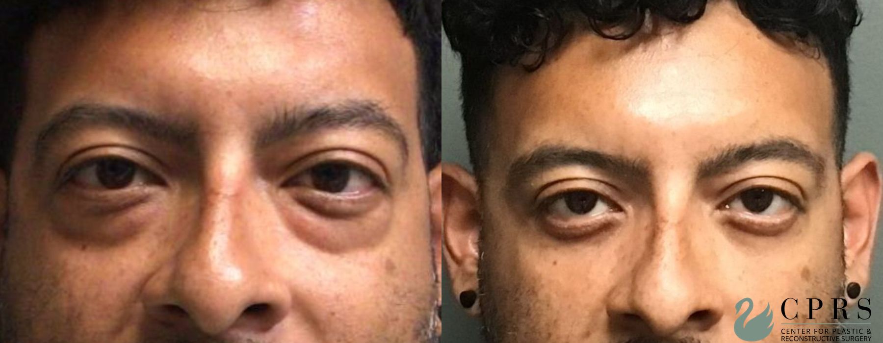 Before and after Blepharoplasty case 19004