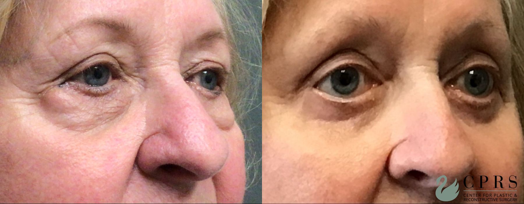 Before and after Blepharoplasty case 23854 - Angle 3