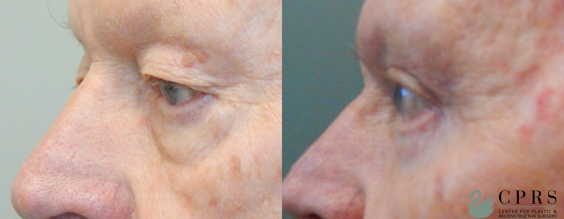 Before and after Blepharoplasty case 18981 - Angle 3