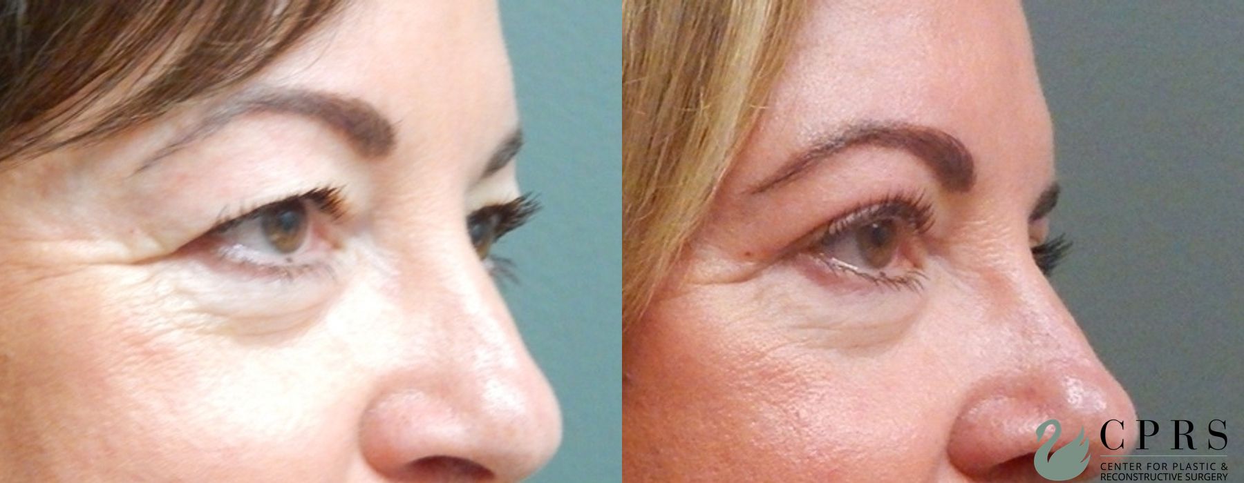 Before and after Blepharoplasty case 18958 - Angle 2
