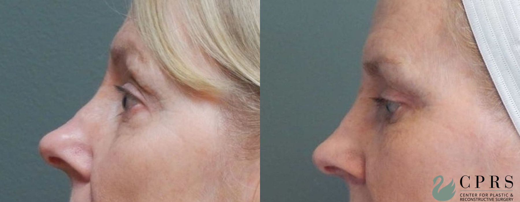 Before and after Blepharoplasty case 18968 - Angle 3