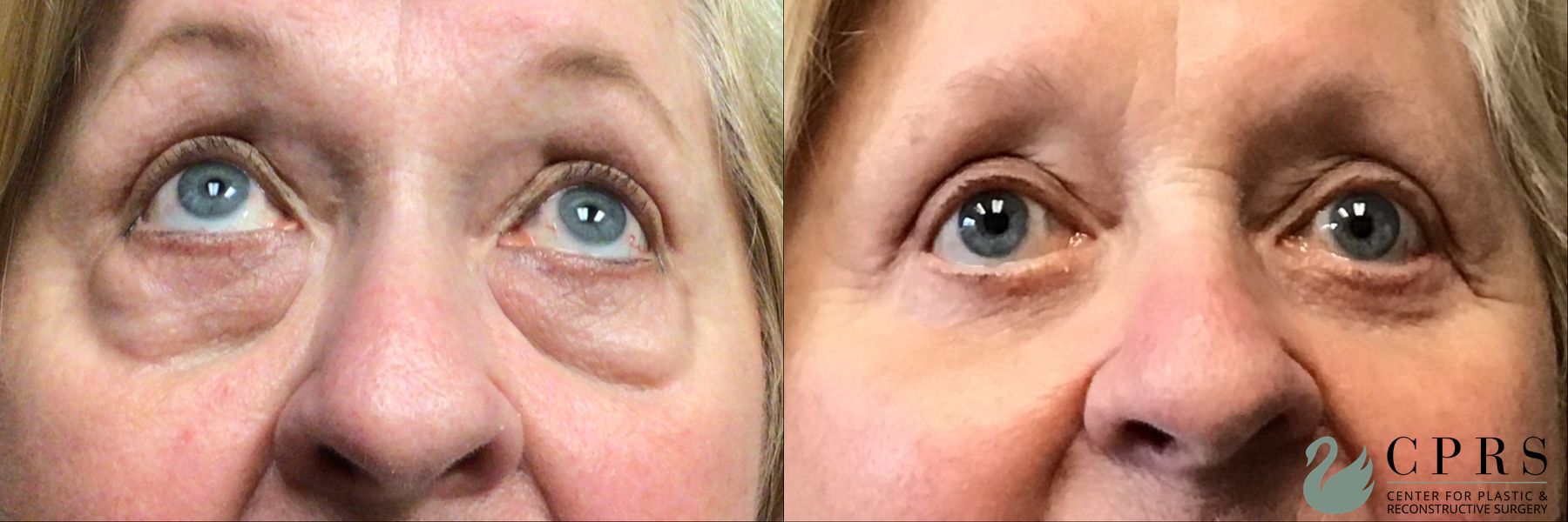 Before and after Blepharoplasty case 23854