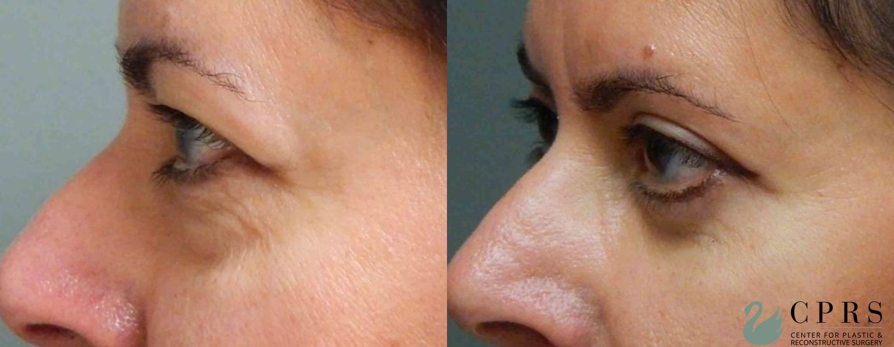 Before and after Blepharoplasty case 18933 - Angle 4