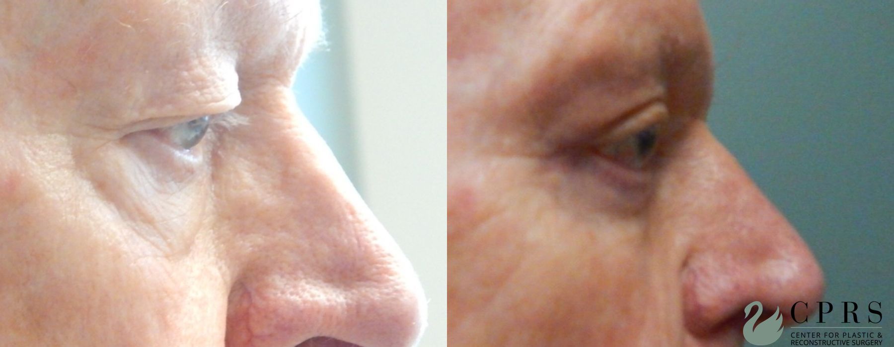 Before and after Blepharoplasty case 18981 - Angle 2