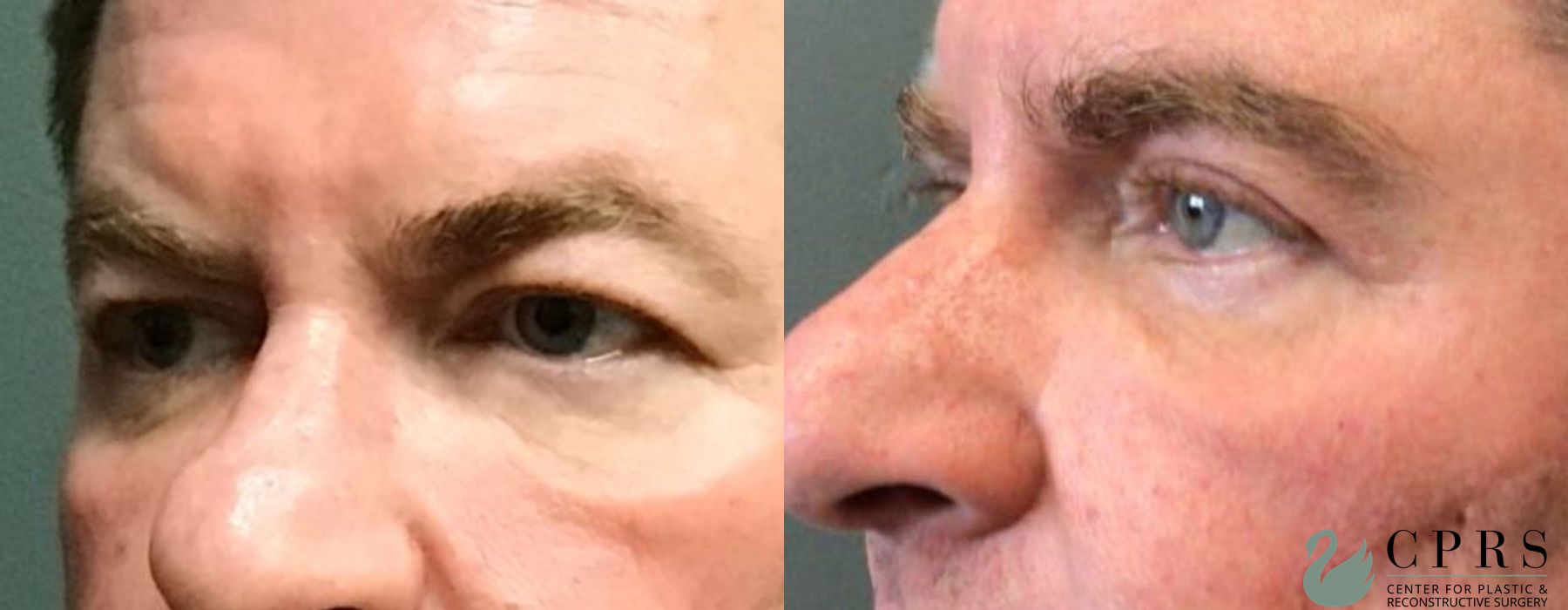 Before and after Blepharoplasty case 19119 - Angle 2