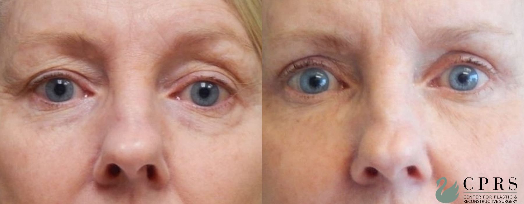 Before and after Blepharoplasty case 18968