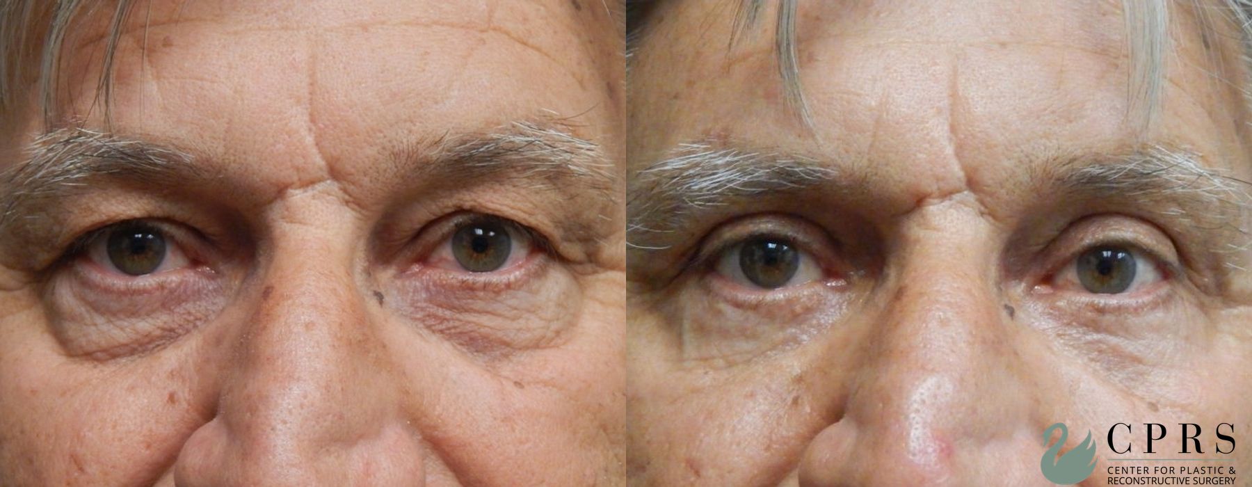 Before and after Blepharoplasty case 19001