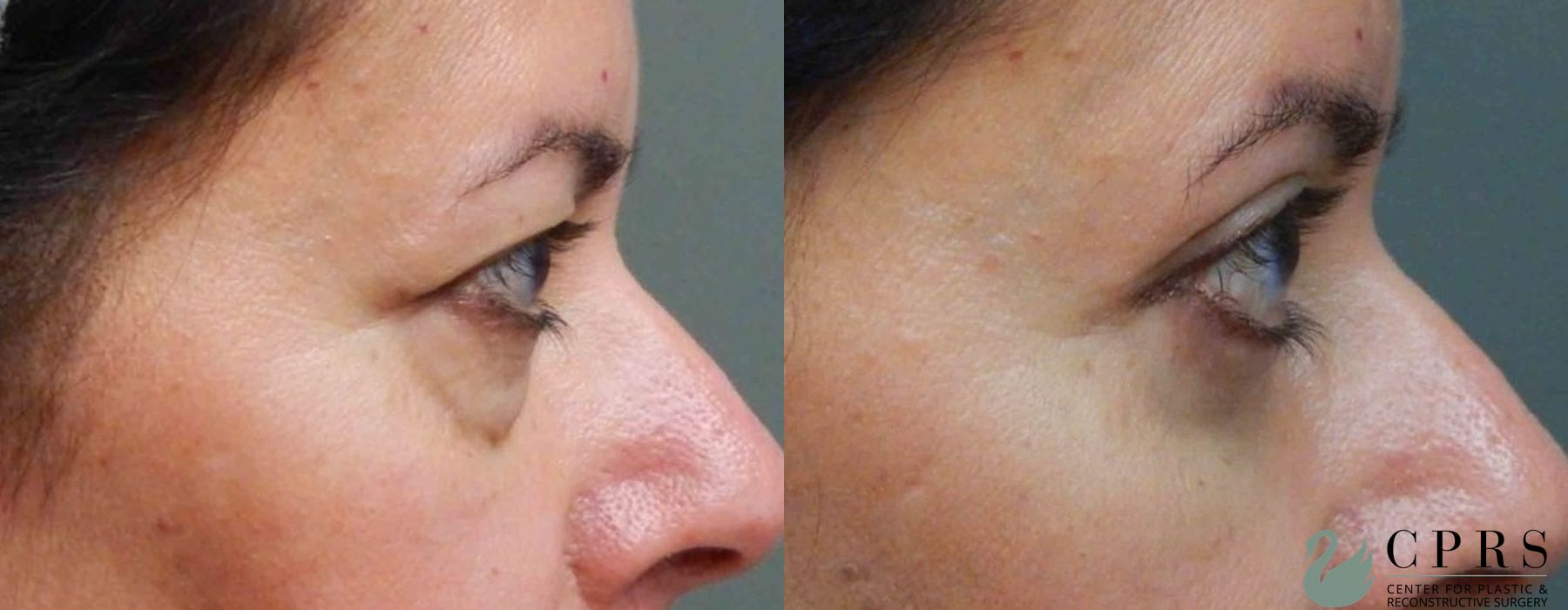 Before and after Blepharoplasty case 18933 - Angle 3