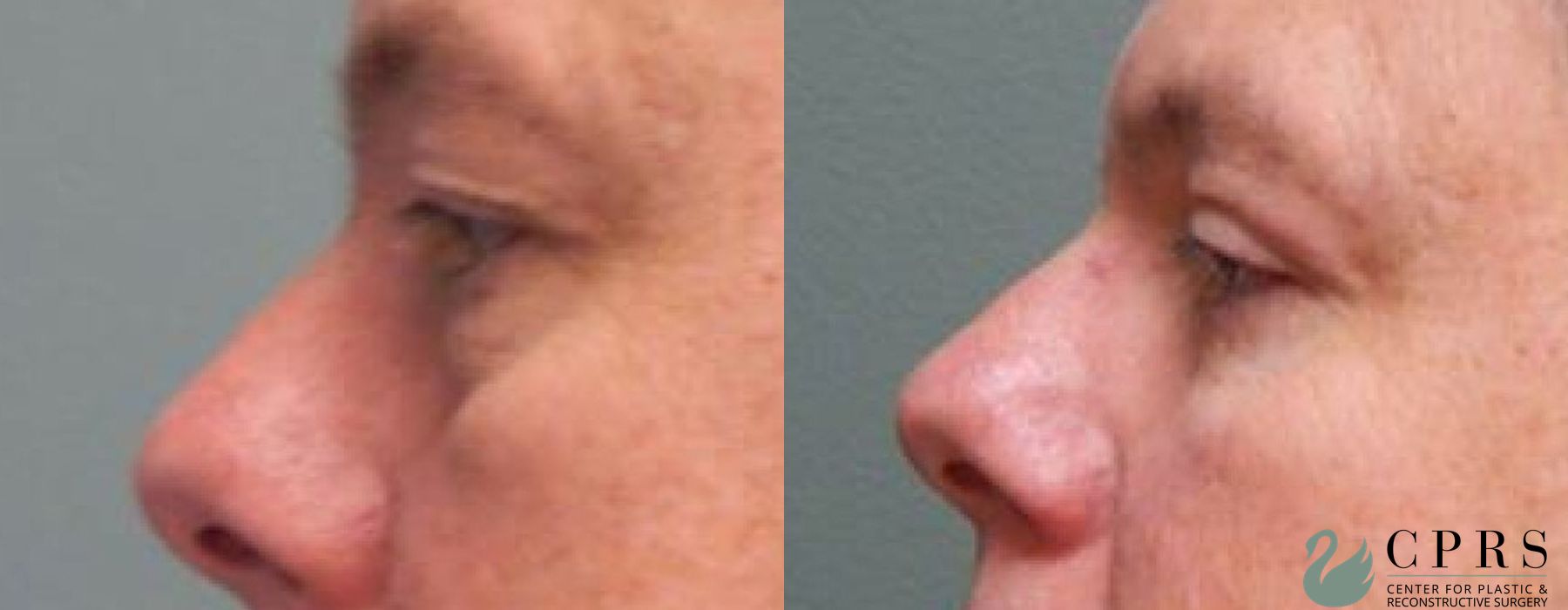 Blepharoplasty - Thumbnail 3