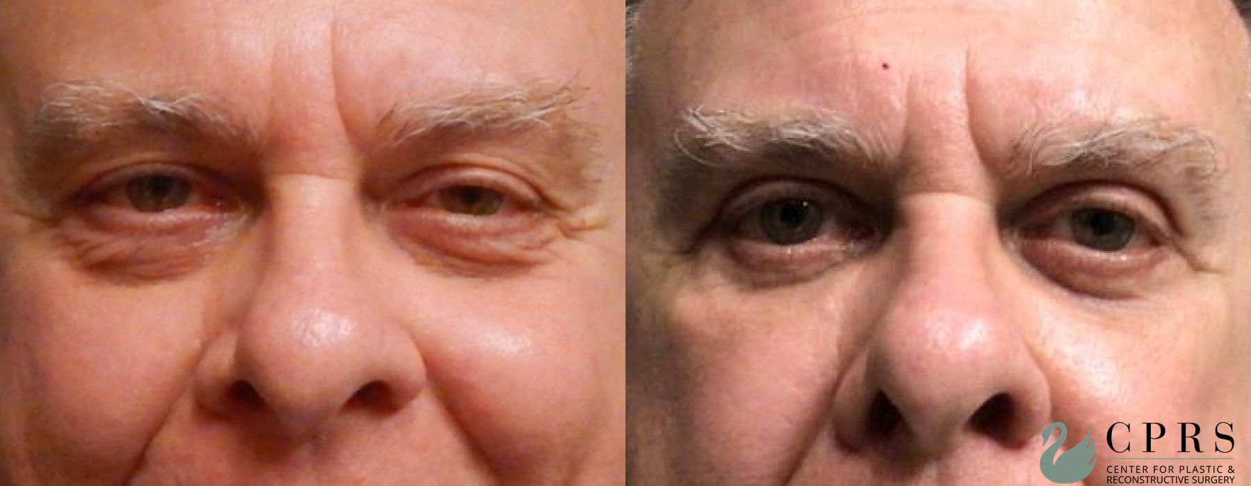 Before and after Blepharoplasty case 18972