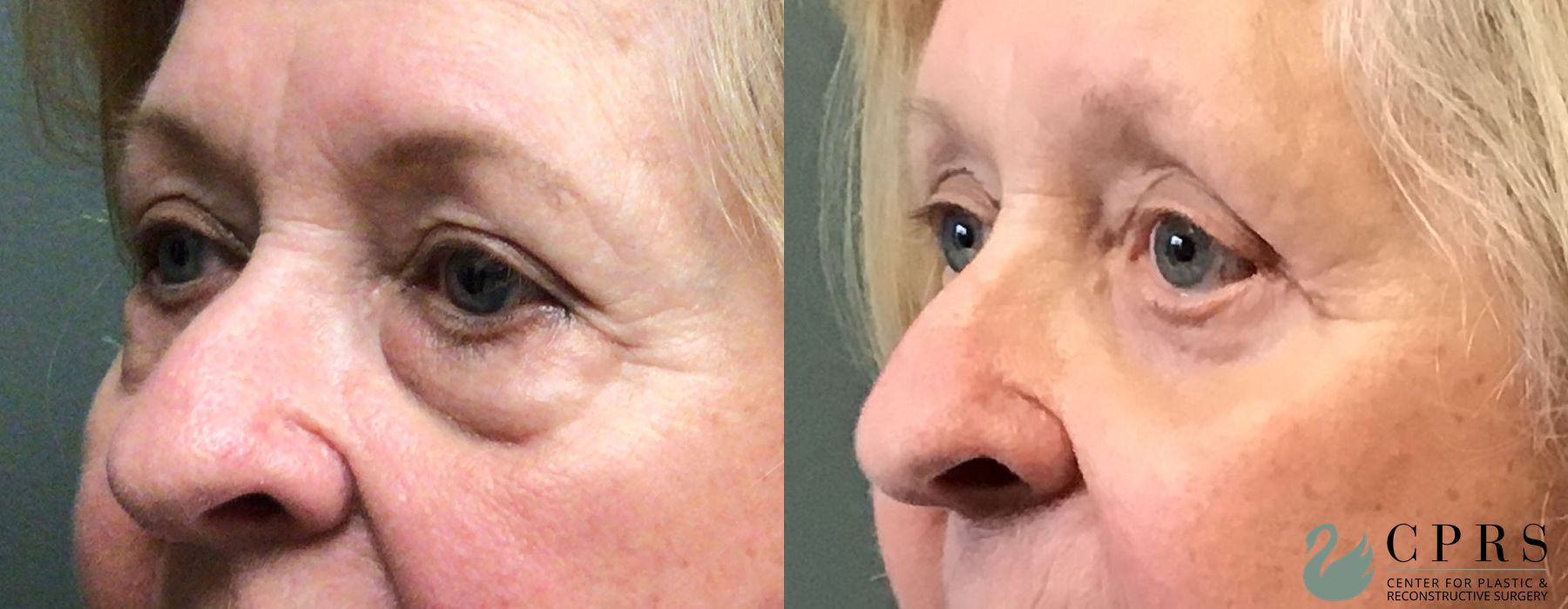 Before and after Blepharoplasty case 23854 - Angle 2