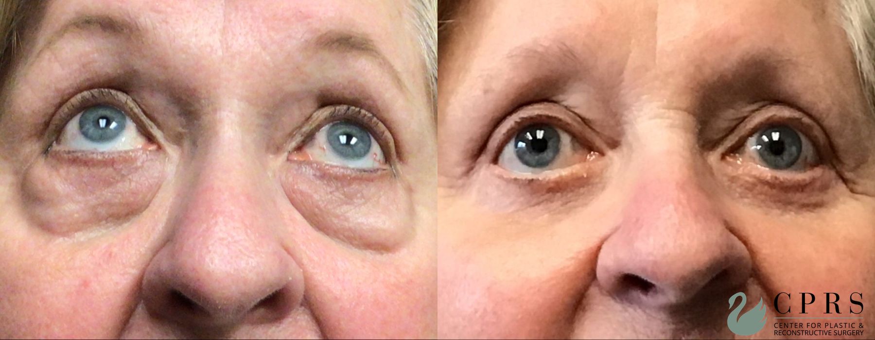 Before and after Blepharoplasty case 23854