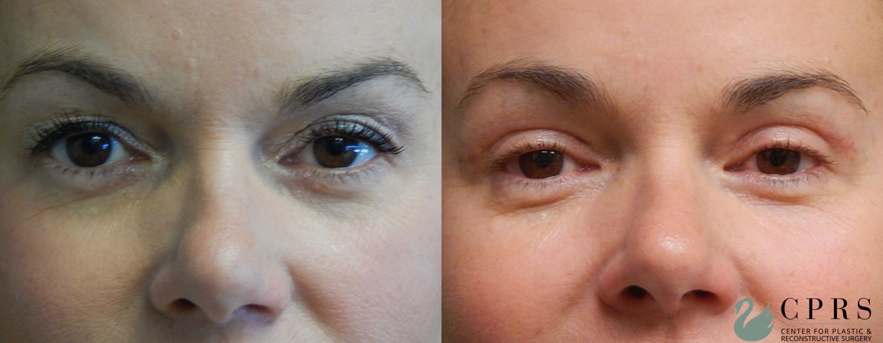 Before and after Blepharoplasty case 18925