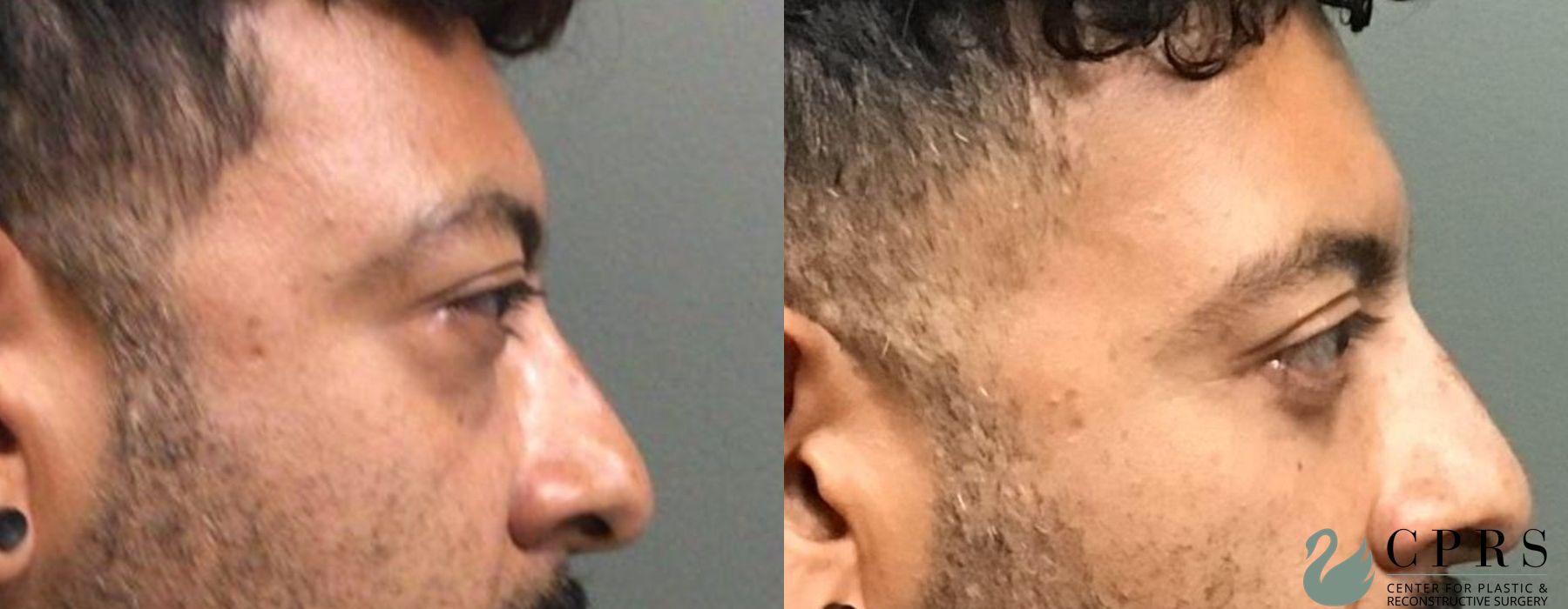 Before and after Blepharoplasty case 19004 - Angle 3
